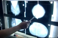 Nyílt mammográfiás- és méhnyak szűrés az Egészségnapok keretében
