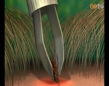 Elkezd�d�tt a kullancsszezon